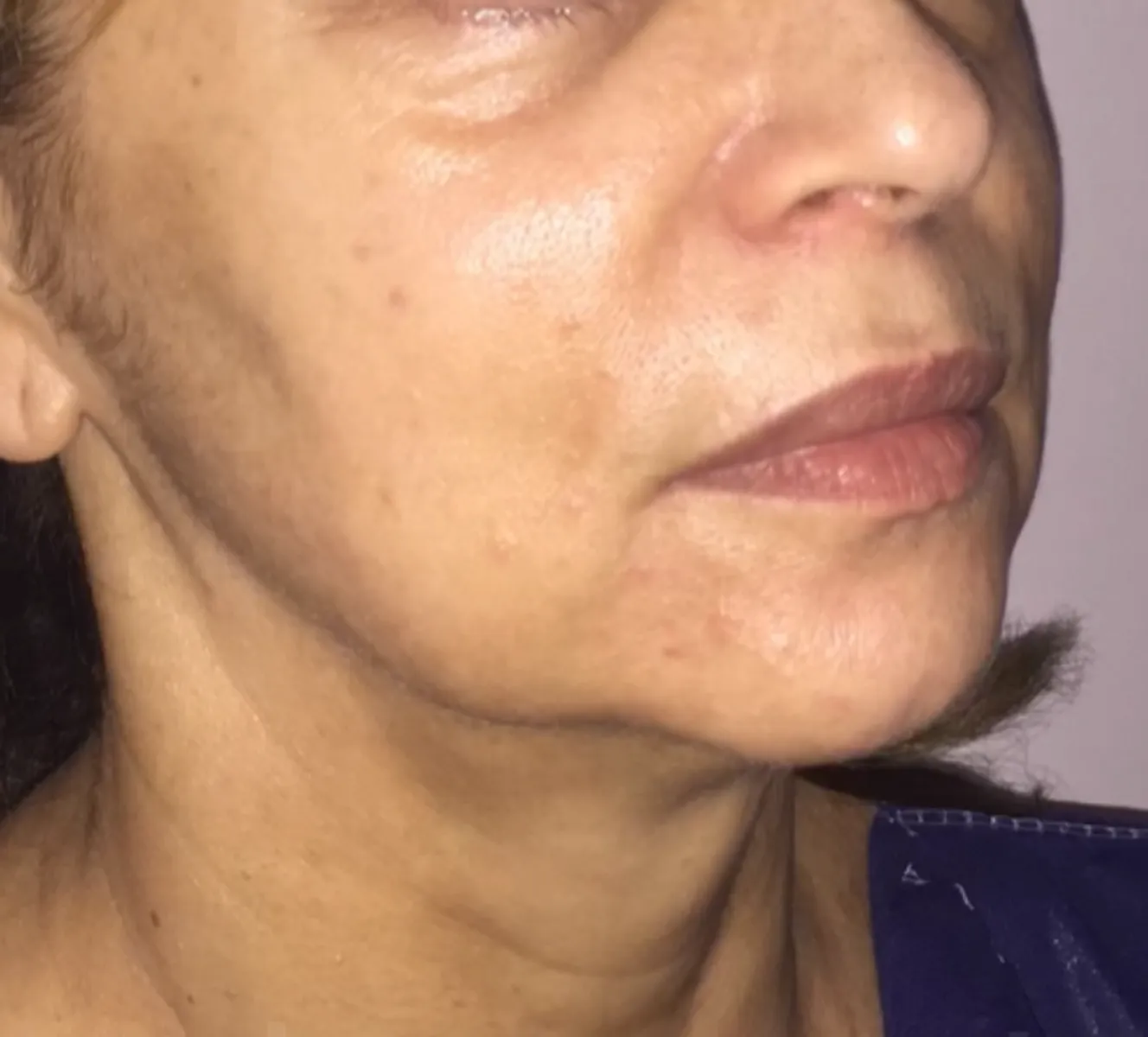 Rosto de perfil antes do facelifting, com flacidez e papada