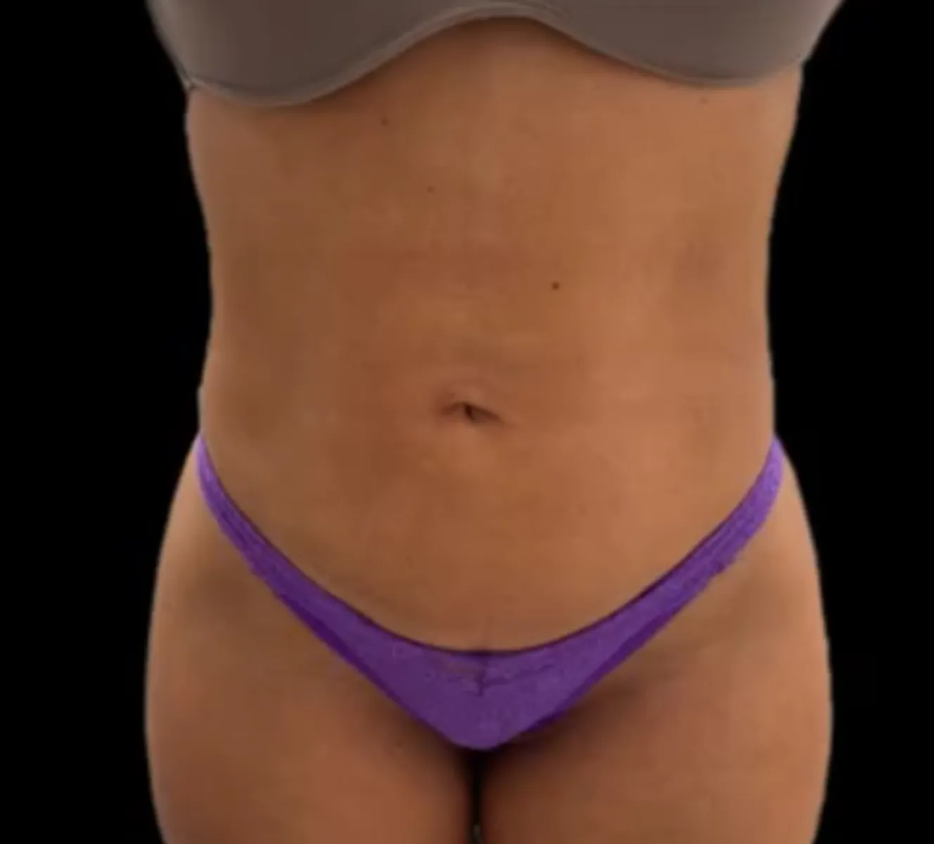 Abdômen e quadril depois da lipo a laser, com contorno mais definido