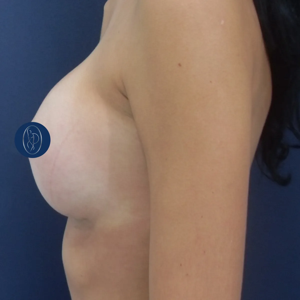 Perfil da mama depois da prótese de recuperação rápida, com volume e projeção naturais
